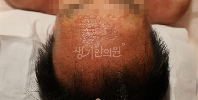 지루성두피염 생활 습관 개선 핵심 5가지