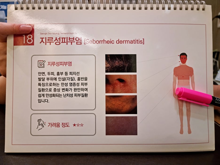 지루성두피염 생활 습관 개선 핵심 5가지