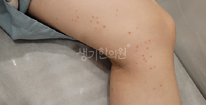상계동피부과증상 편평사마귀제거 후 올바른 관리법은?