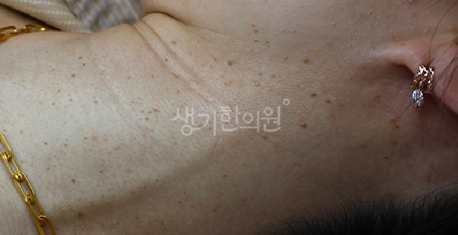 상계동피부과증상 편평사마귀제거 후 올바른 관리법은?
