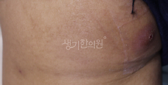 화농성한선염 재발 원인 자꾸 곪는 이유와 관리 포인트