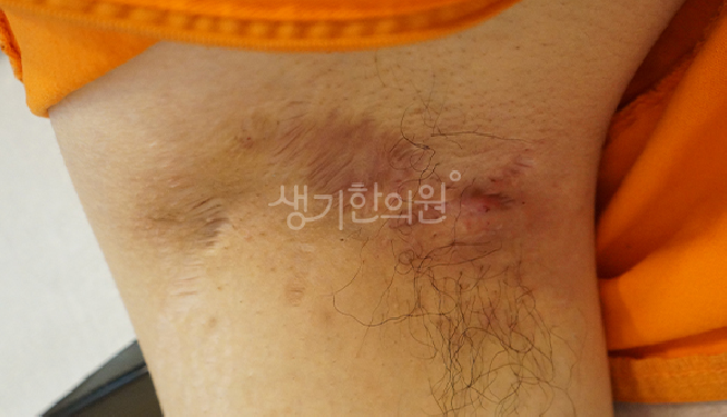 화농성한선염 재발 원인 자꾸 곪는 이유와 관리 포인트