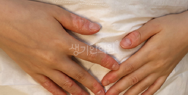 한포진 피부과 증상 관리 한의원 치료 병행이 도움되는 이유