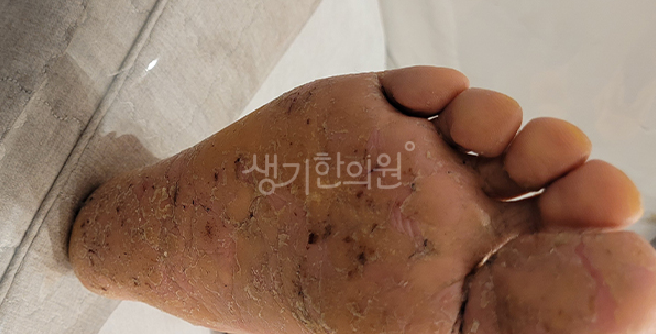 한포진 피부과 증상 관리 한의원 치료 병행이 도움되는 이유