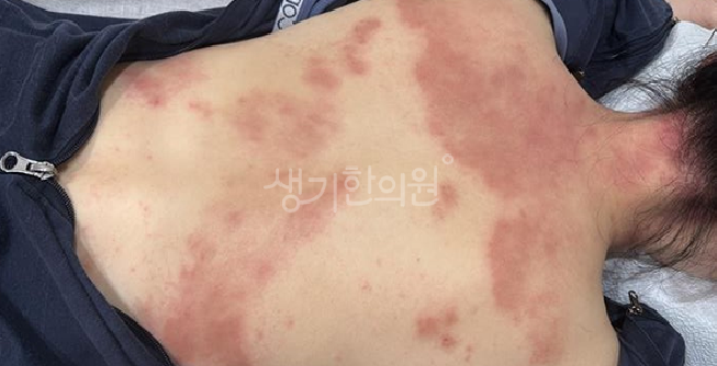 아토피 피부과 증상 초기 발진과 일반 건조증 구별하는 방법