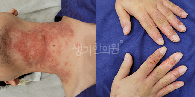 아토피 피부과 증상 초기 발진과 일반 건조증 구별하는 방법