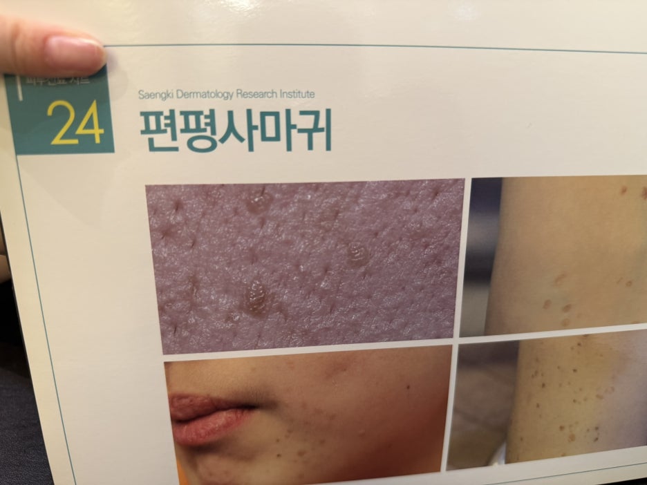 2030 편평사마귀 원인 특징 직장인 스트레스와 면역 저하로 인한 급격한 확산