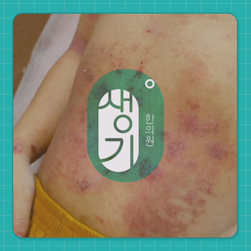 피부가려움증 치료 과정에서 긁어서 생긴 상처와 2차 감염을 예방하는 법