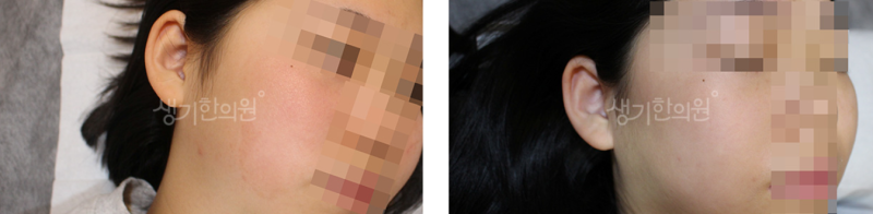 만성 지루성피부염 가려움과 비듬으로 타인 시선 신경 쓰일 때