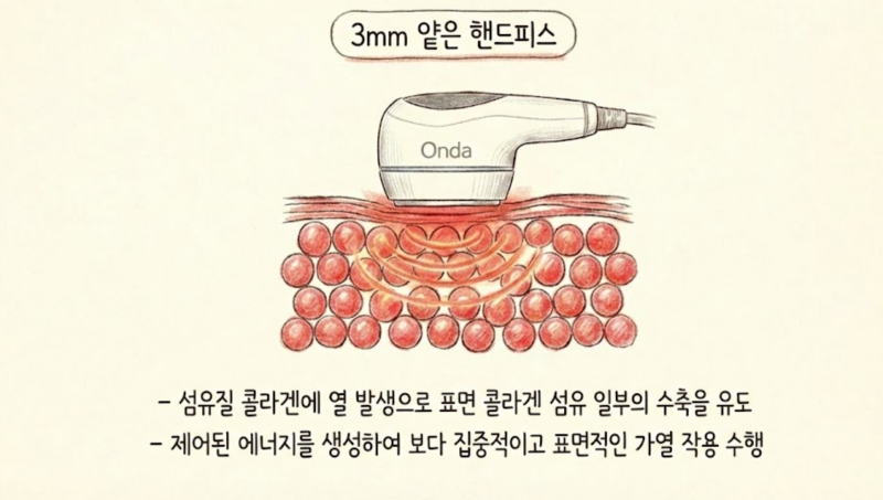 온다의 얕은 핸드피스와 피부층을 그린 원문 원리 참고도식