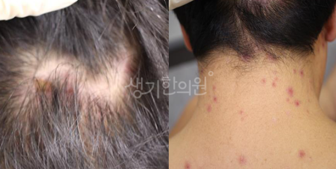 두피 지루성피부염 반복되는 이유 무엇일까?