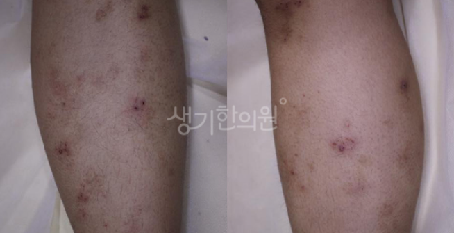 얼굴 아토피 초기증상을 확인해보세요