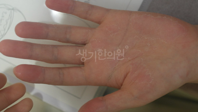 율하피부과원인으로 다한증이 심해졌다면