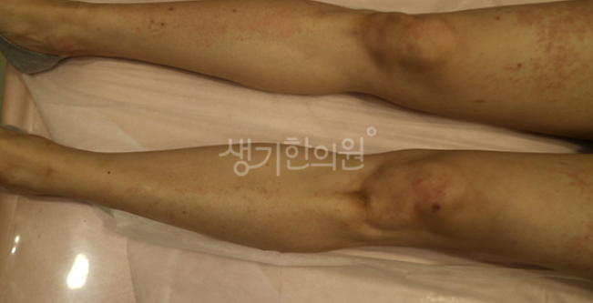 콜린성두드러기, 온도 변화 대처법을 알려드립니다.