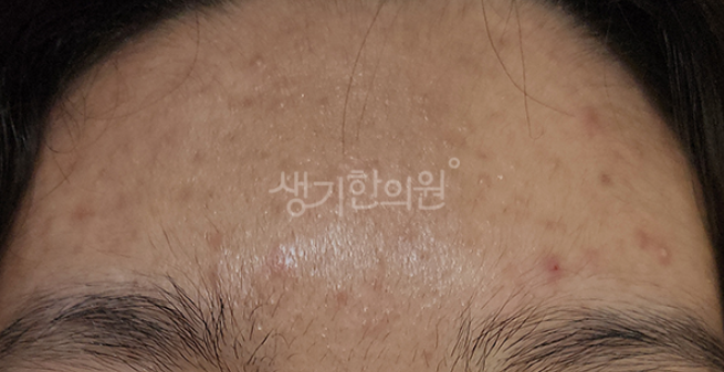 여드름 없애는 법 무조건 짜는 게 답이 아니다?