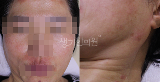 얼굴 건선 초기증상 놓치지마세요