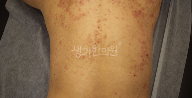 피부전신가려움증 치료와 함께 습관 관리가 중요합니다