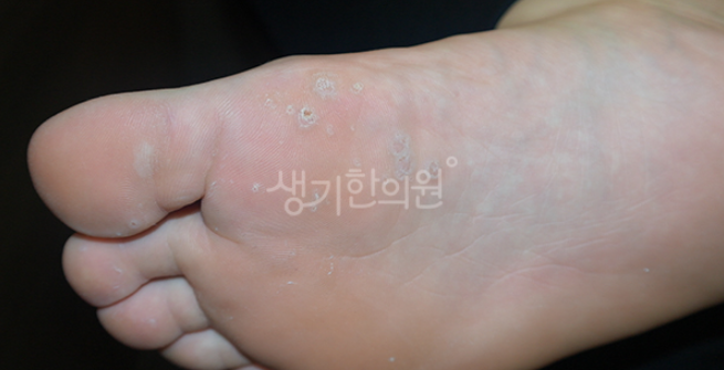 천안쌍용동피부과질환 사마귀 봄부터 증가하는 이유