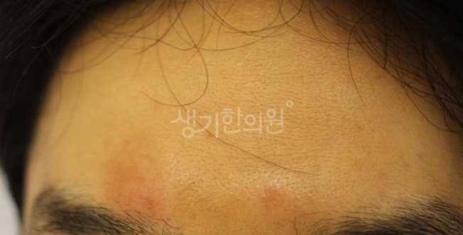 지성피부 관리 방법? 제대로 해야 '이거' 막을 수 있다