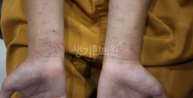 아토피 피부 치료만으로 좋아지지 않는 이유는?