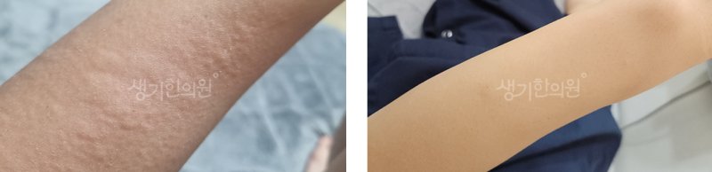 갑자기 올라온 두드러기에 대처하는 법