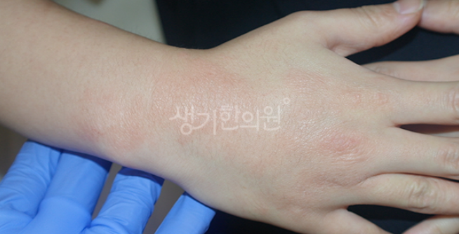 손등 습진 고무장갑 때문이었다고? 진실은