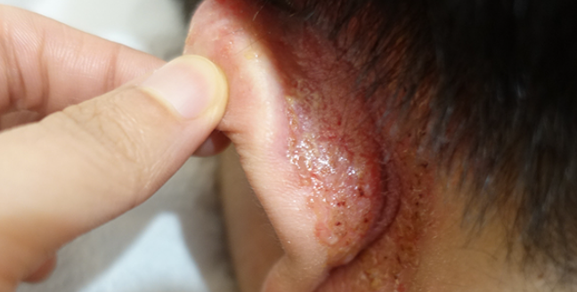 지루성두피염 치료 후 관리 샴푸까지 신경써야 재발안돼