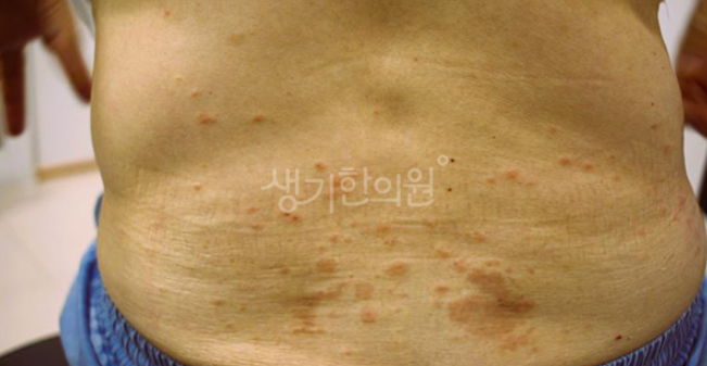 전신두드러기 증상 절대 가볍게 넘겨서는 안 됩니다