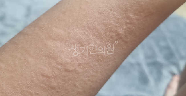 도안동피부과질환 알레르기 봄만되면 찾아오는 불청객?