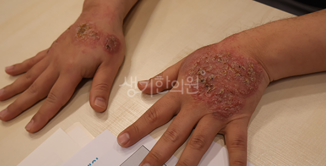 동전 모양 화폐상습진 치료 방법 이렇게 해보세요