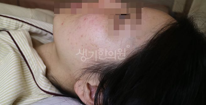 편평사마귀 원인 바이러스 감염 대처법은?