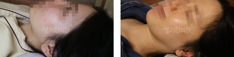 편평사마귀 원인 바이러스 감염 대처법은?