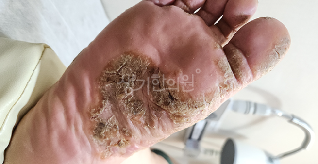 자가면역질환 건선 낫지않는 이유는?