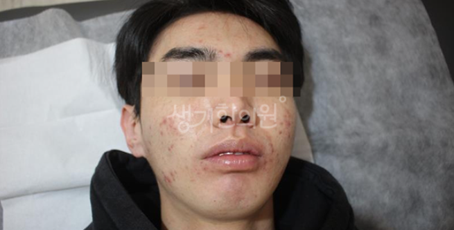 마포피부과질환 여드름이 고민인 분들께