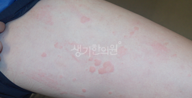 해운대두드러기한의원 치료가 도움되는 이유