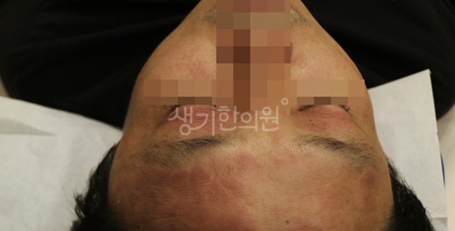 안면 지루성피부염 증상 n년차 좋아질 수 있을까?