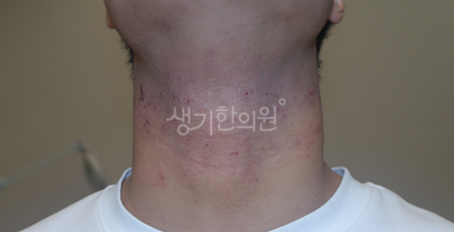 아이 아토피흉터 색소침착 생기기 전에 케어해주세요