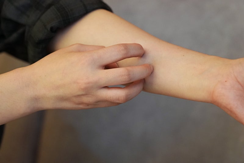 아이 아토피흉터 색소침착 생기기 전에 케어해주세요