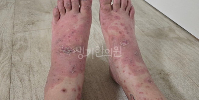 무좀약 바르면 더 악화되는 화폐상습진 어떻게 해야할까