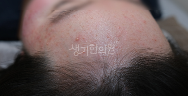 생유산균 장내 환경과 피부 건강 연관성 정말 있을까?