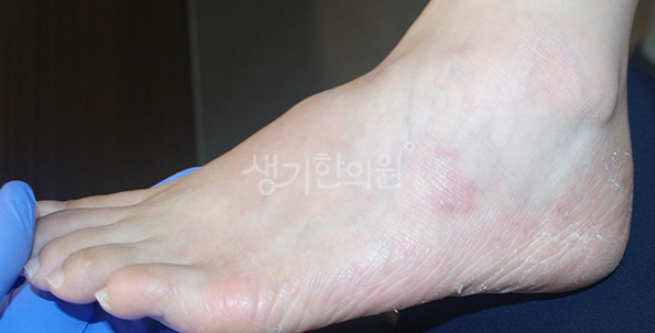천호동습진한의원 개인별 체질에 따라 접근해야