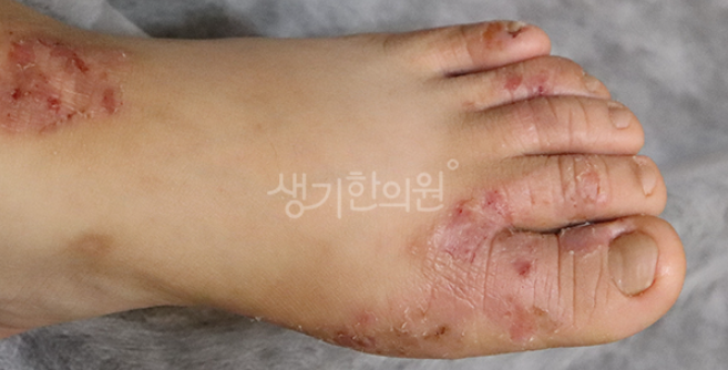 아토피 초기 증상 헷갈릴 때?