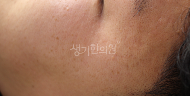광주편평사마귀 유독 봄에 심해지는 분들께