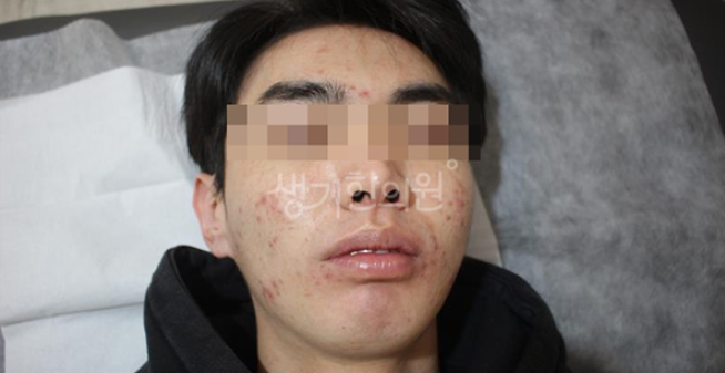 덕천피부과질환 여드름 부위별 원인에 따라 접근해야