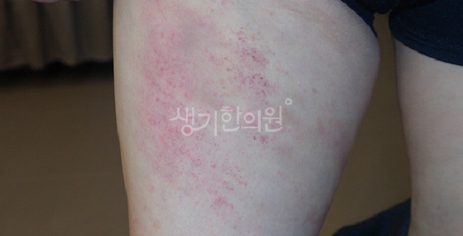 허벅지 콜린성 두드러기가 생기는 이유