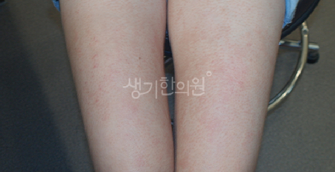 아기 아토피 유전된다 정말일까?