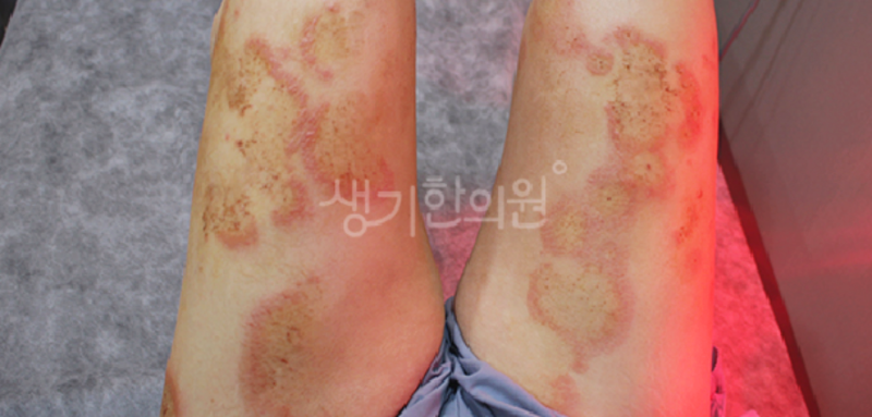 여름철 사타구니습진 곰팡이균 저절로 없어지지 않아요