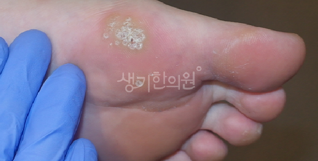 사마귀 치료 방법 개인에 따라 다르게 선택해야
