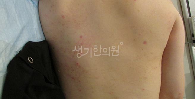 면역력 저하 두드러기 증상 방치하지 마세요