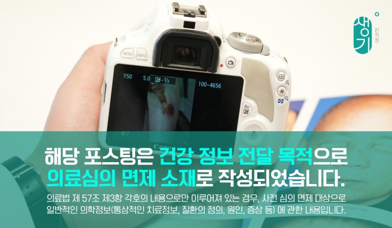 지루성피부염 피지분비 막아도 계속되는 이유